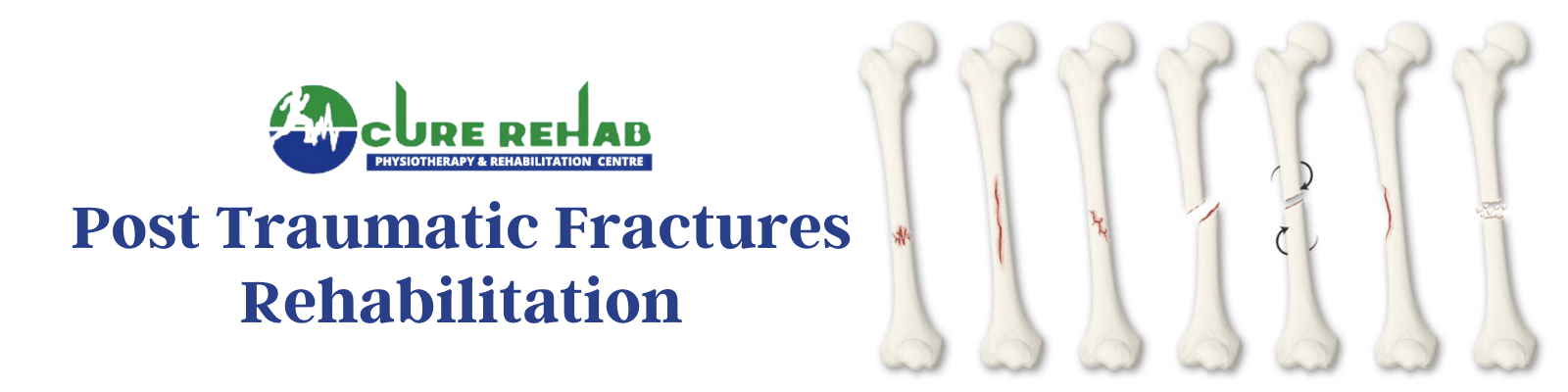 Post Traumatic Fractures Care at Cure Multispeciality Rehab